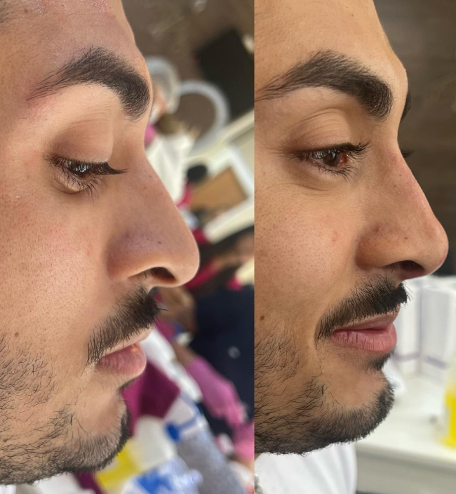 A rinomodelação é um procedimento estético não cirúrgico que utiliza o ácido hialurônico para corrigir imperfeições no nariz, proporcionando um contorno mais harmonioso e natural, sem a necessidade de cirurgia plástica.