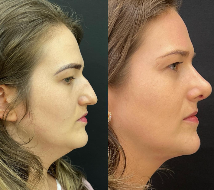 A rinomodelação é um procedimento estético não cirúrgico que utiliza o ácido hialurônico para corrigir imperfeições no nariz, proporcionando um contorno mais harmonioso e natural, sem a necessidade de cirurgia plástica.