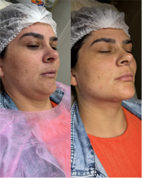 Resultado de lipo de papada